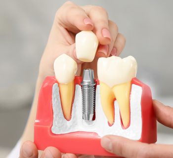 Three Types of Dental Implants: Their Uses, Pros and Cons